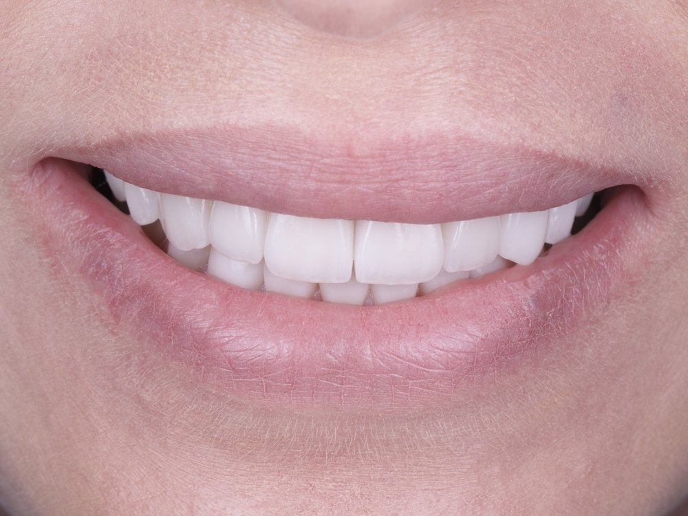 Sonrisa después del tratamiento, caso 1