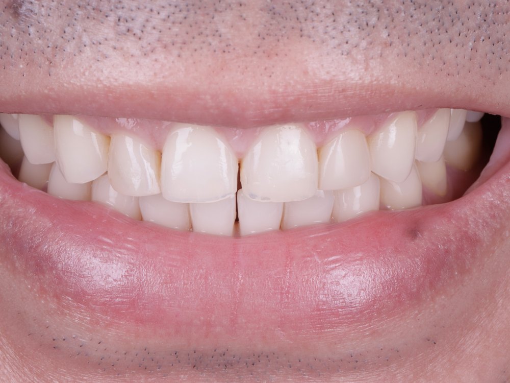 Sonrisa antes del tratamiento, caso 2