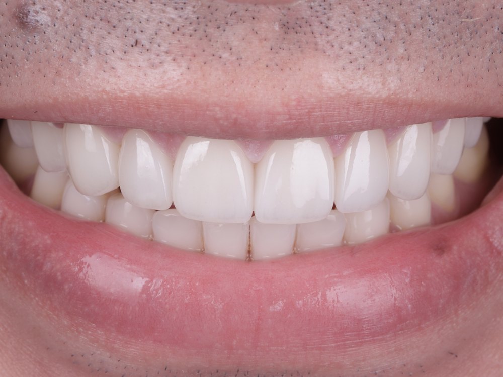 Sonrisa después del tratamiento, caso 2