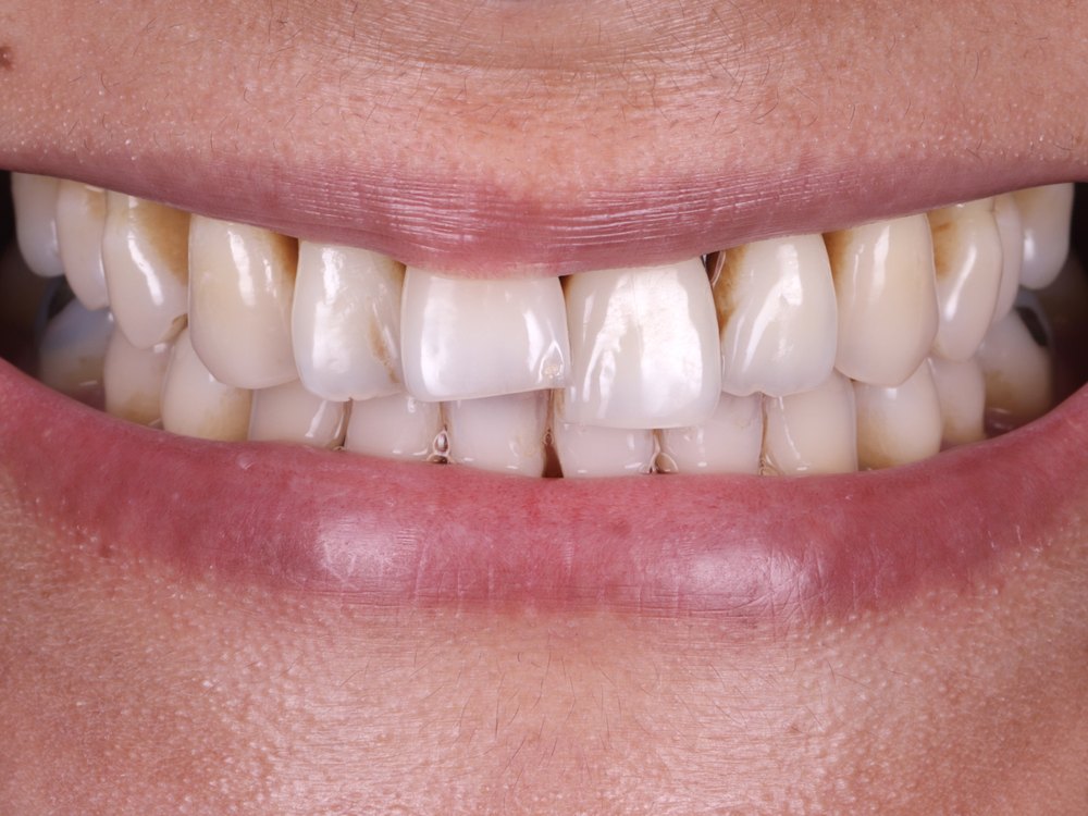 Sonrisa antes del tratamiento, caso 3