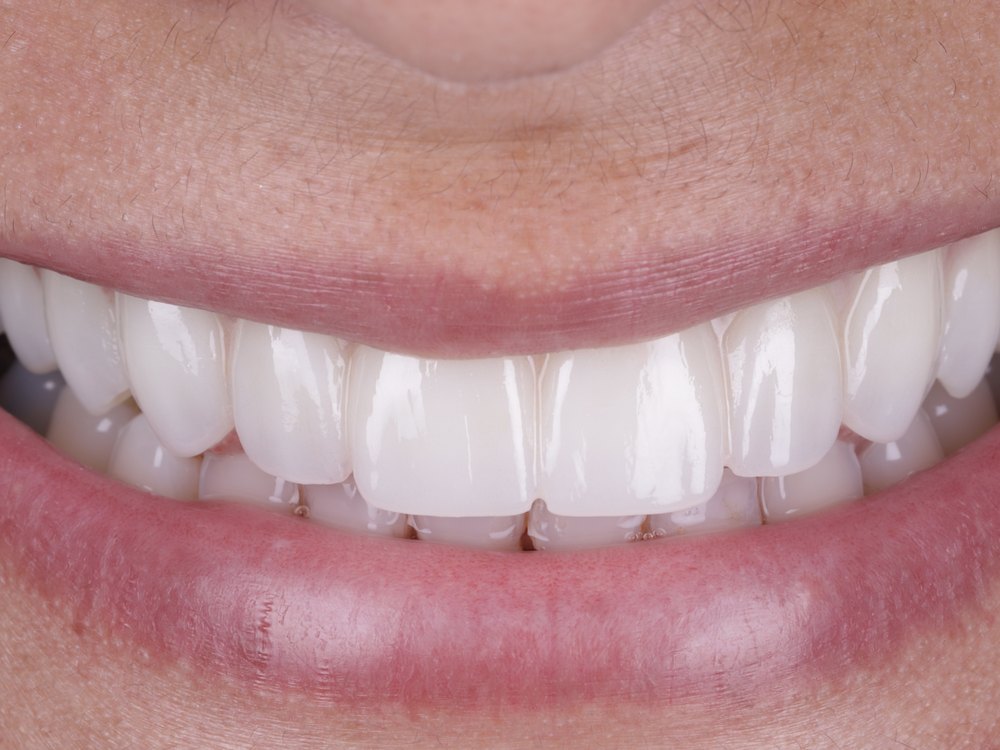Sonrisa después del tratamiento, caso 3